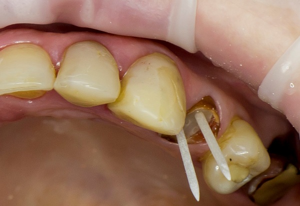 Основы восстановления зуба в стоматологии стекловолоконным штифтом