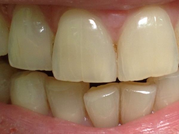 Разновидности трещин на эмали зубов