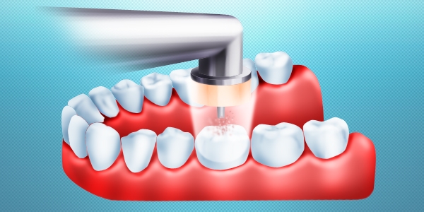 Лечения зубов лечение озоном thumbnail