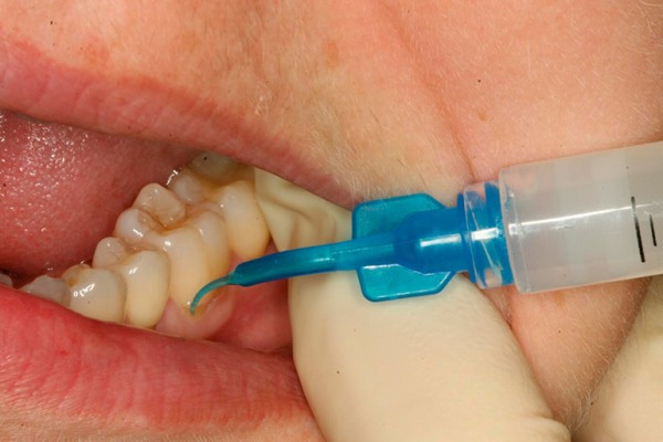 Зубы и лечение озоном thumbnail