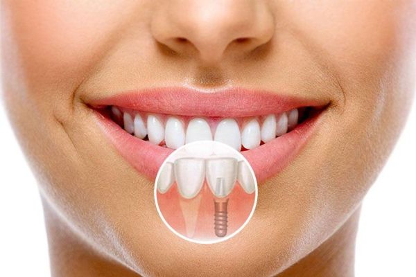 Методики имплантации передних зубов