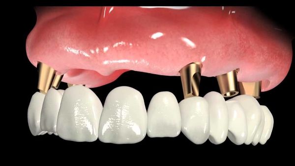 Возможные осложнения после комплексной имплантации зубов