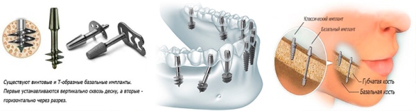 Противопоказания к имплантации зубов курение thumbnail