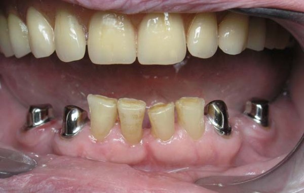 Телескопические протезы зубные на верхнюю челюсть отзывы