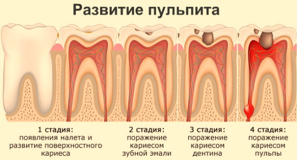 Инфекция в канале зуба симптомы и лечение