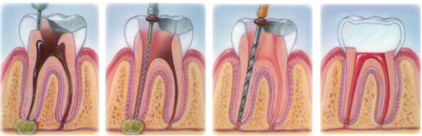 Как удаляют кисту корня зуба