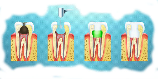 Распространение и лечение инфекции зуба