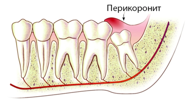 Симптомы и лечение инфекции зуба