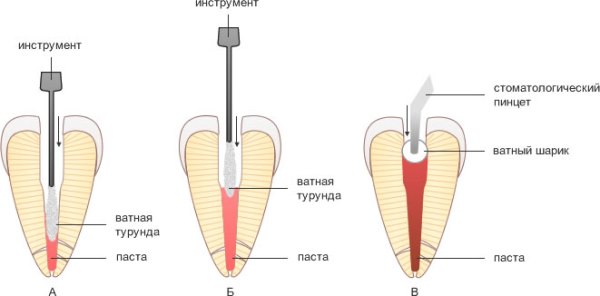 Метапекс в стоматологии инструкция противопоказания thumbnail