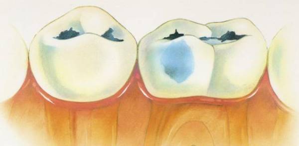 вторичный кариес депульпированного зуба
