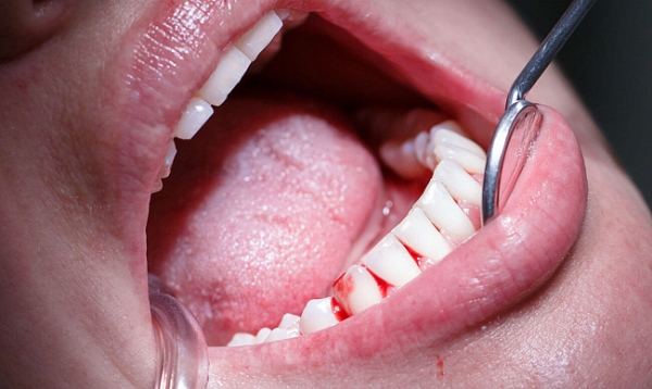 Метод лечения при травме зуба thumbnail