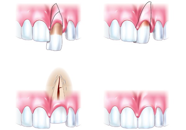 Травма передних зубов лечение thumbnail
