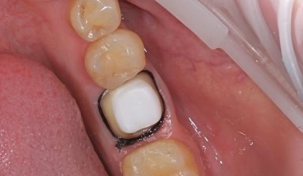 Металлическая вкладка в зуб под коронку
