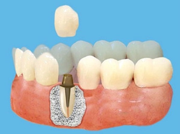 Показания к постановке металлической вкладки в зуб