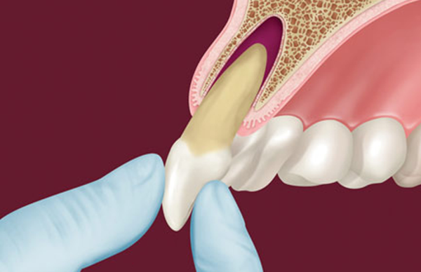 Травма зуба тактика лечения thumbnail