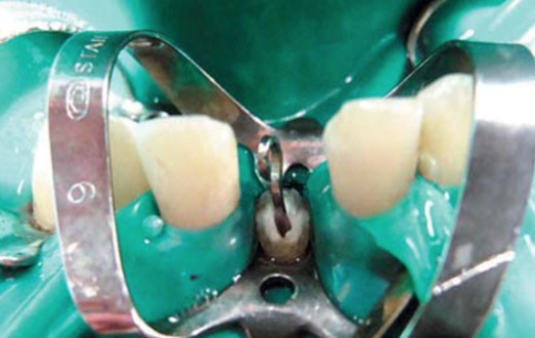 Ортодонтическое лечение ретинированного зуба thumbnail