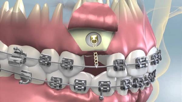 Этапы проведения ортодонтического вытяжения зуба