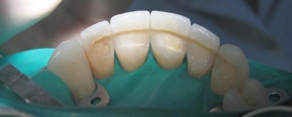 Особенности препарирования зуба под пластмассовую коронку