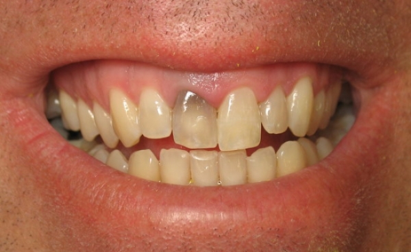 Потемнение зубов может определяться двумя доминантными генами