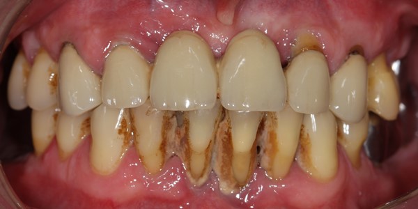 Потемнение зуба у десны у ребенка