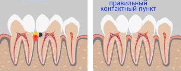 Контактный пункт между зубами