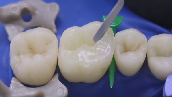 Контакты между зубами лечение thumbnail