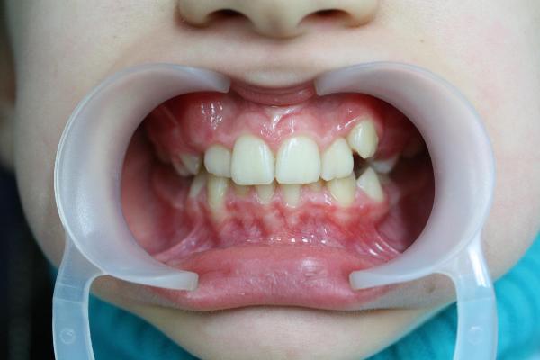 Ортодонтическое вытяжение зуба