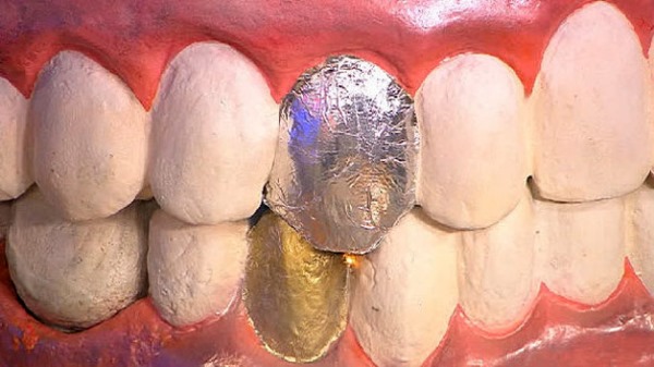 Синдром гальванизма в стоматологии