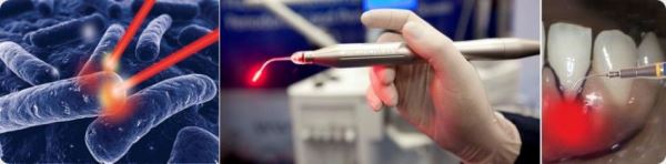 Фотодинамическая терапия в стоматологии противопоказания thumbnail