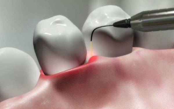 Антимикробная фотодинамическая терапия в стоматологии