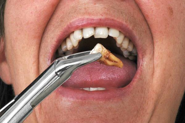 Нужно ли удалять зубы мудрости при установке брекетов