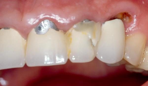 Аллергия на пластмассовые зубные коронки