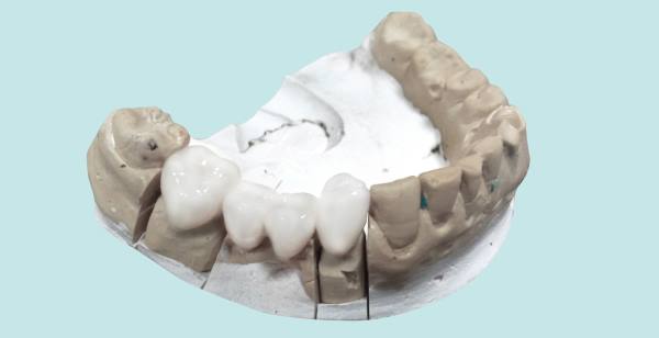 Способы протезирования зубов при большом их отсутствии