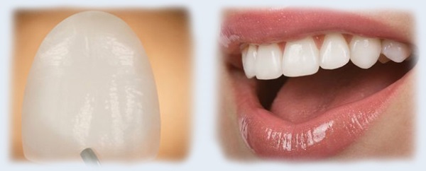 Как долго болят зубы после установки виниров thumbnail