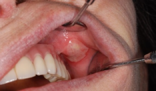 После лечения и протезирования зубов все болит thumbnail