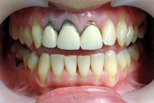 Лечение зубов после протезирования thumbnail