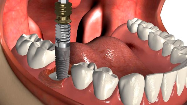 Что делать, если выпадает имплант зуба