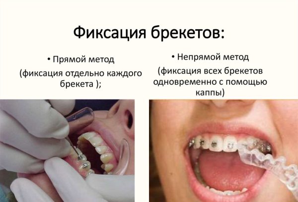Этапы лечения зубов брекет thumbnail