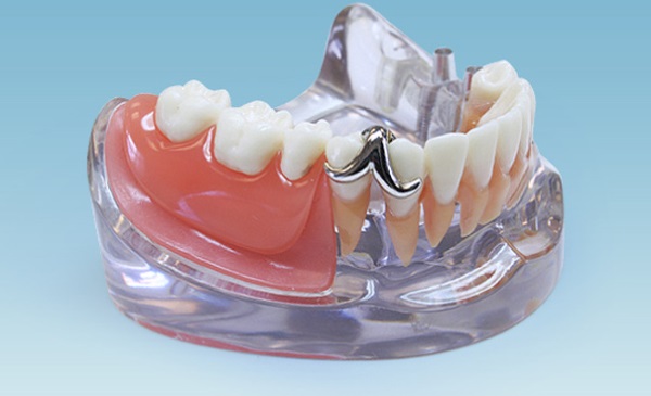 Зубные протезы которые не вызывают аллергии thumbnail