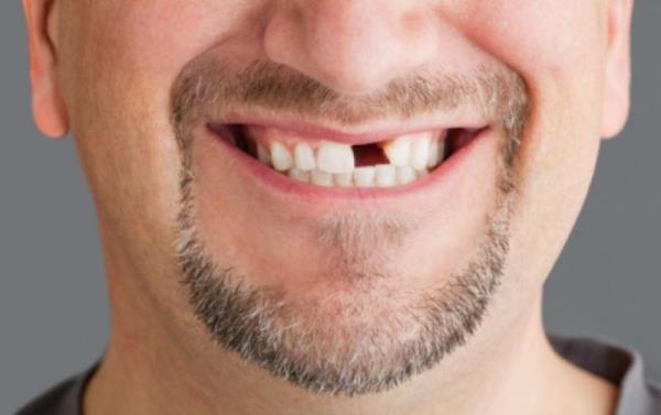 Через какое время проводится протезирование после удаления зуба
