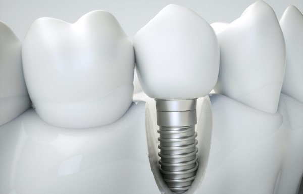 Срок эксплуатации титанового импланта зуба