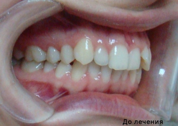 Адекватная коррекция вестибулярного положения зубов