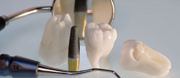 Показания к ультразвуковой имплантации зубов