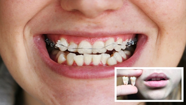 Скученность зубов и лечение thumbnail