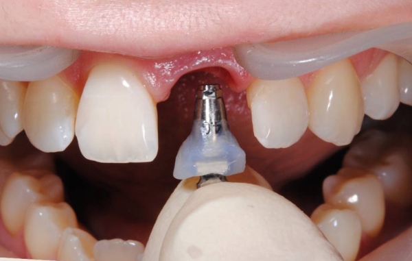 Подготовка к установке импланта сразу после удаления зуба