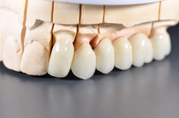 Рекомендации по уходу за безметалловой коронкой на зуб