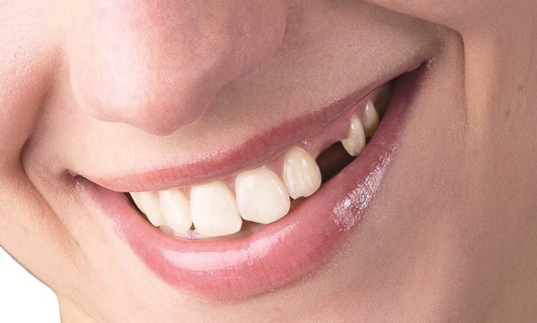 Особенности несъемных зубных протезов при частичном отсутствии зубов