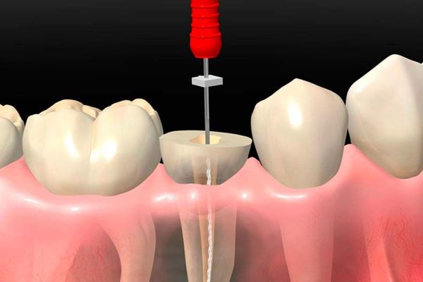 Зачем нужна депульпация зуба перед протезированием