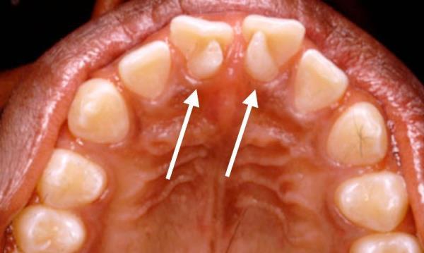 Как выглядит инвагинация зуба