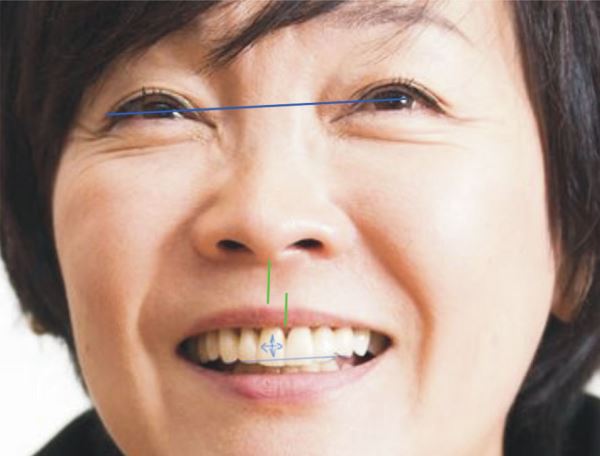 Методы коррекции смещения средней линии зубов